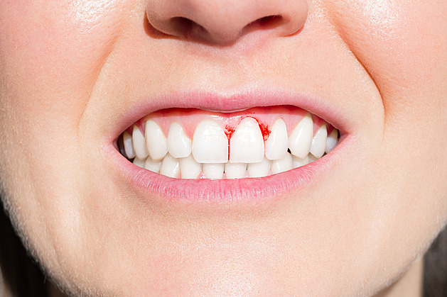 Parodontóza: příznaky, které byste neměli podceňovat. Ohrožuje celé tělo